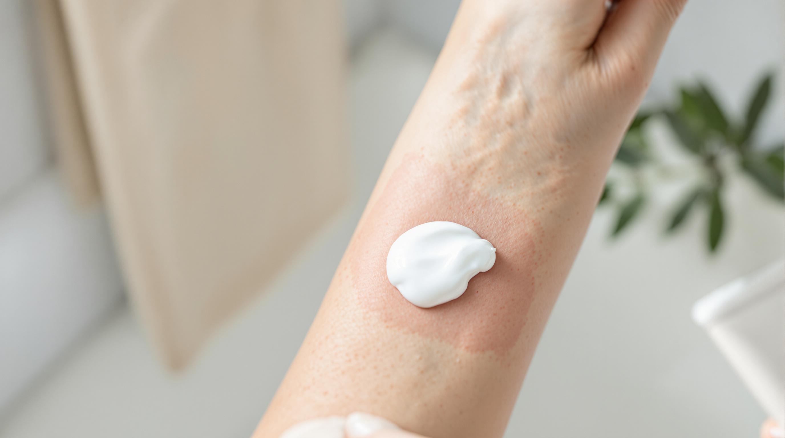 Crème appliquée sur un coup de soleil sur un avant-bras.